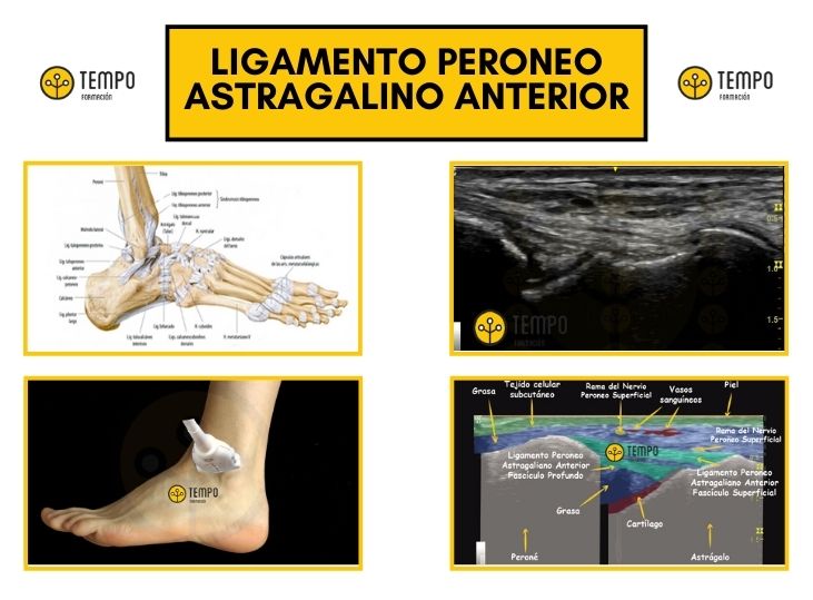 caso-clinico-ligamento-peroneo-astragalino-anterior